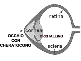 cheratocono